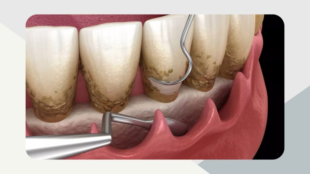 Teeth Cleaning Price List In Philippines 2024   Scaling And Root Planing Cleaning 1024x576 