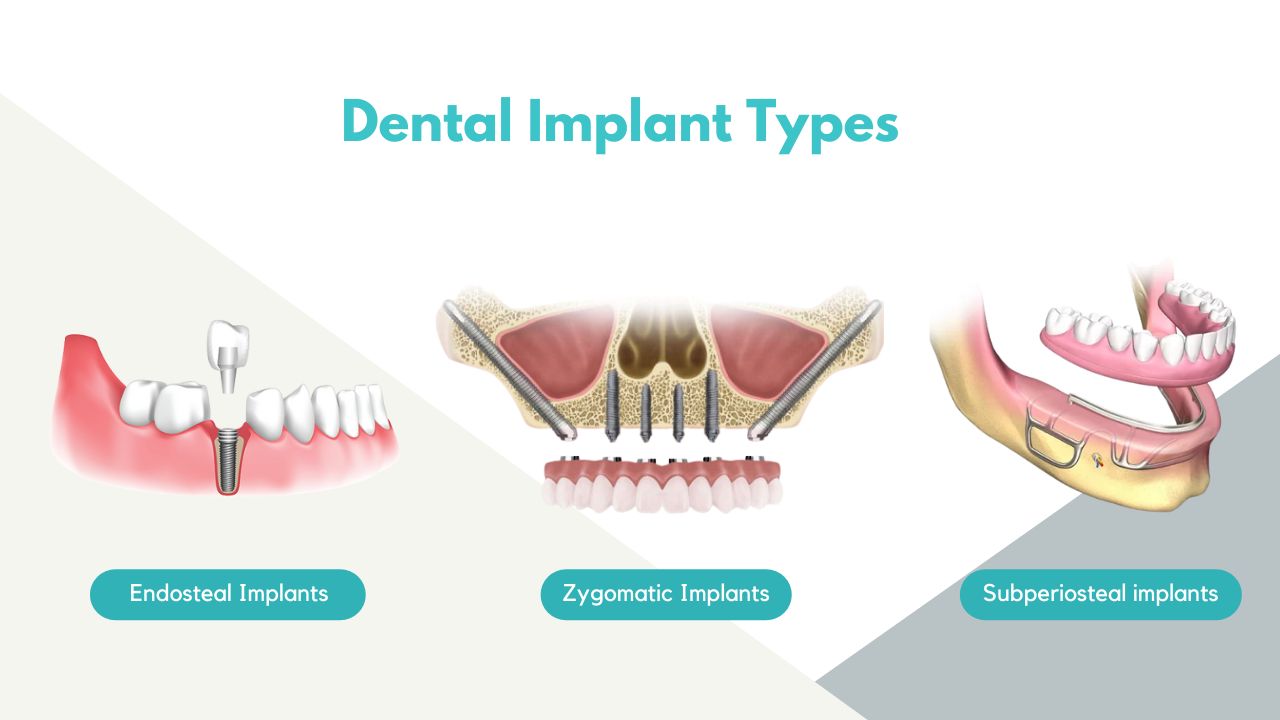 √ Dental Implant Price and Types Philippines 2024
