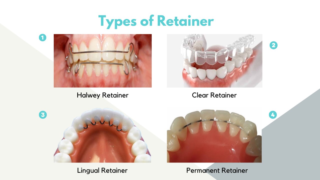 √ Retainer Price and Types in Philippines 2024