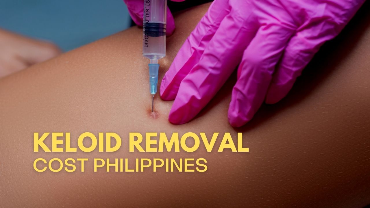 complete-keloid-removal-cost-and-types-philippines-2024